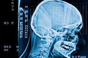 Photo of brain scan 