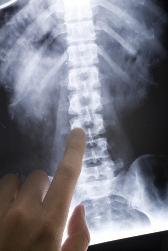Photo of Back and Spinal Cord Injuries