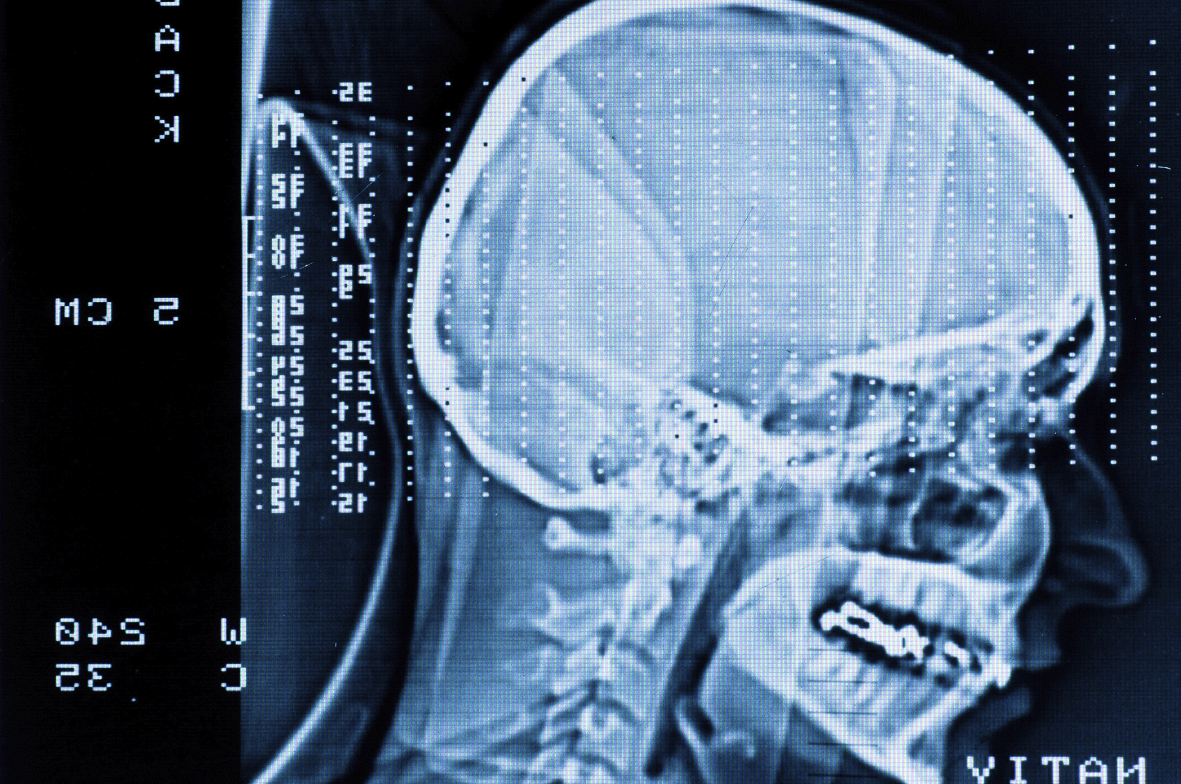 Closeup of a CT scan with brain and skull on it