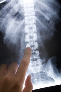 After a spinal cord injury, the lifetime medical costs can be staggering.